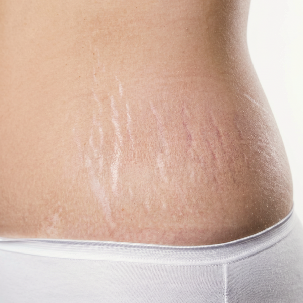 stretch marks