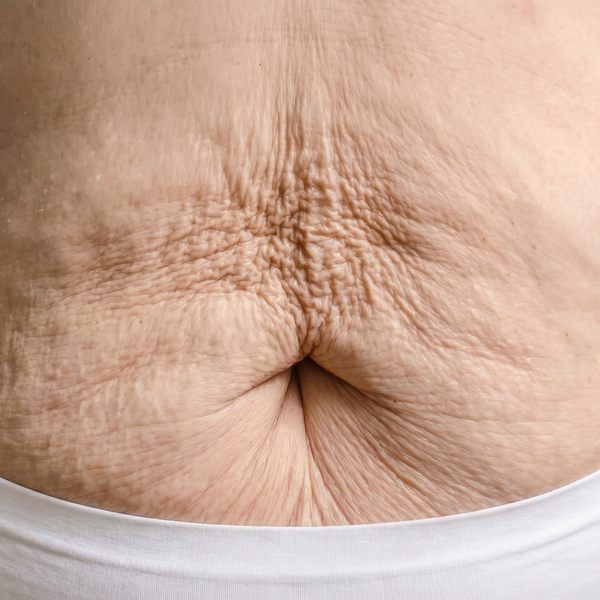 loose skin