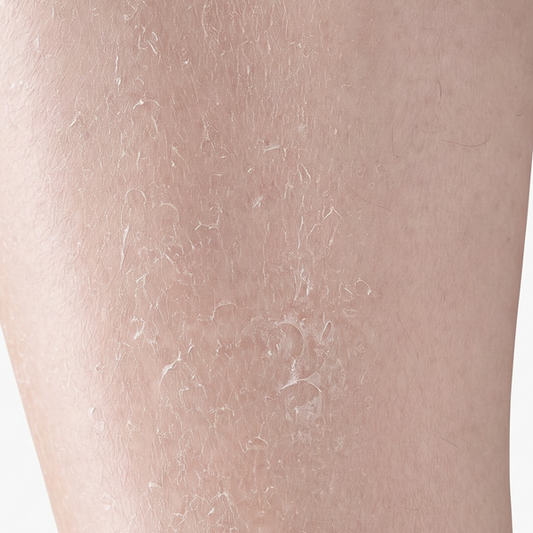 dry skin